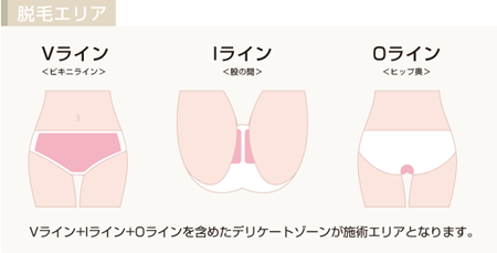 ハイジニーナ脱毛の部位